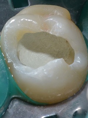 歯髄（神経）温存療法